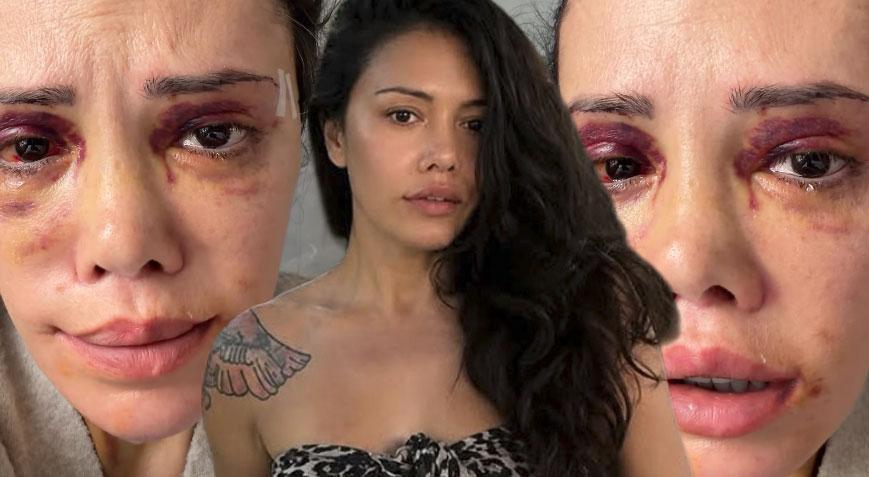 Yüz naklinin ardından revizyon ameliyatı olmuştu! Didem Ceran gözyaşlarına boğuldu Img